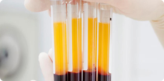 PLASMA RICO EN PLAQUETAS  (PRP)